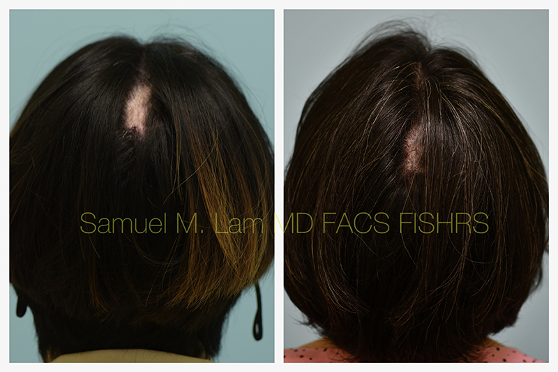 Scalp micropigmentation Before and After Photo by Dr. Lam in Plano TX