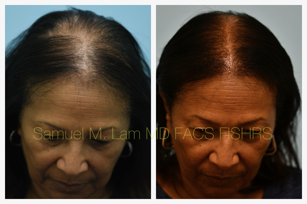 African American Hair Transplant Before and After Photo by Dr. Lam in Plano, TX