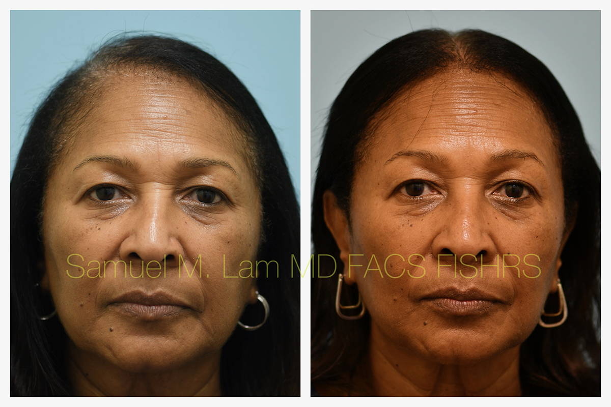 African American Hair Transplant Before and After Photo by Dr. Lam in Plano, TX