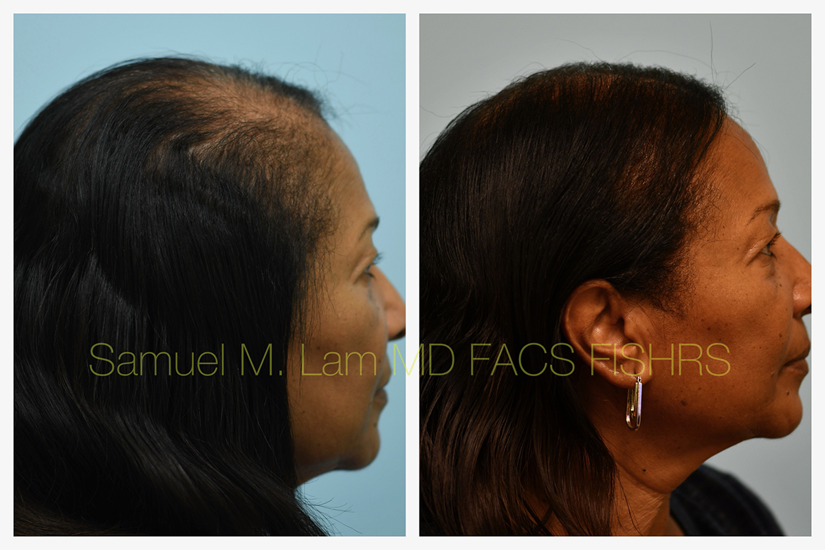 African American Hair Transplant Before and After Photo by Dr. Lam in Plano, TX