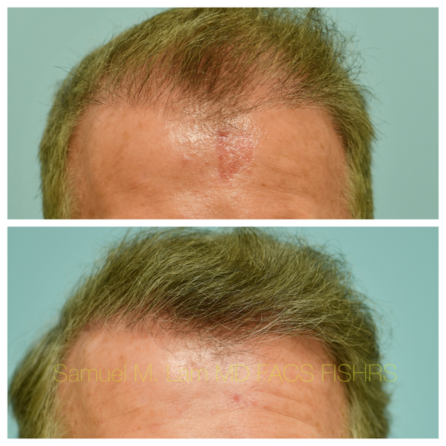 Hairline and Central Density Before and After Photo by Dr. Lam in Plano, TX