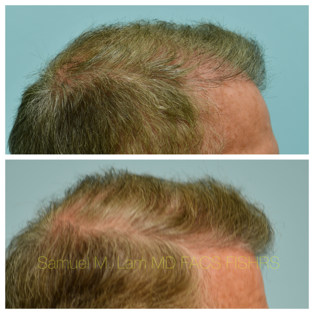 Hairline and Central Density Before and After Photo by Dr. Lam in Plano, TX