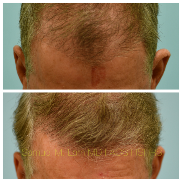 Hairline and Central Density Before and After Photo by Dr. Lam in Plano, TX