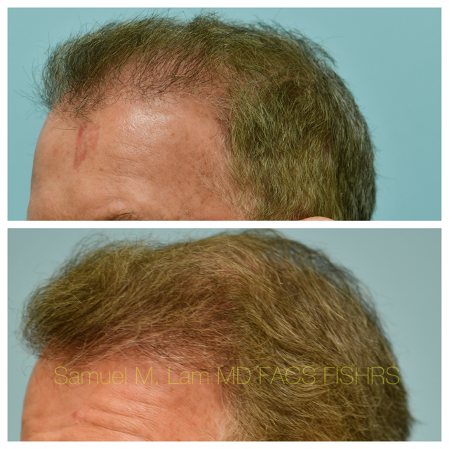 Hairline and Central Density Before and After Photo by Dr. Lam in Plano, TX