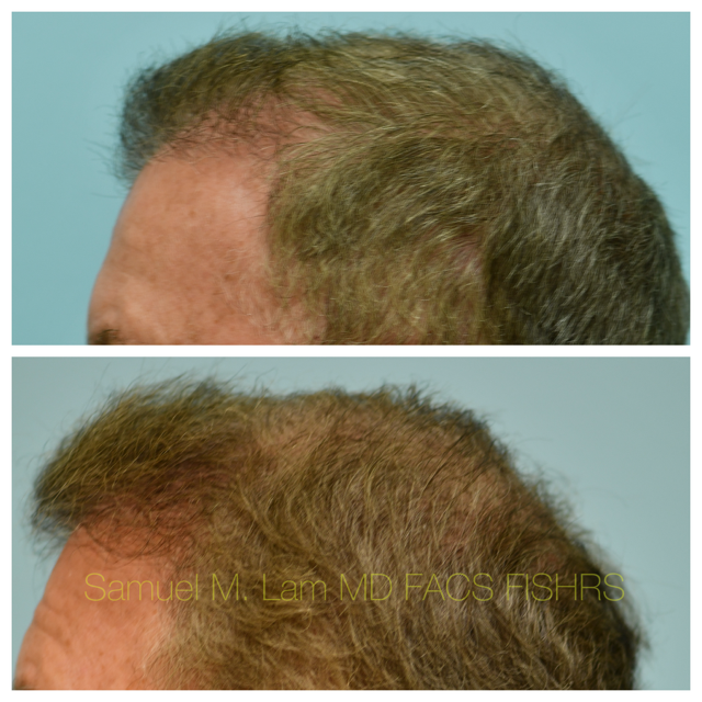 Hairline and Central Density Before and After Photo by Dr. Lam in Plano, TX