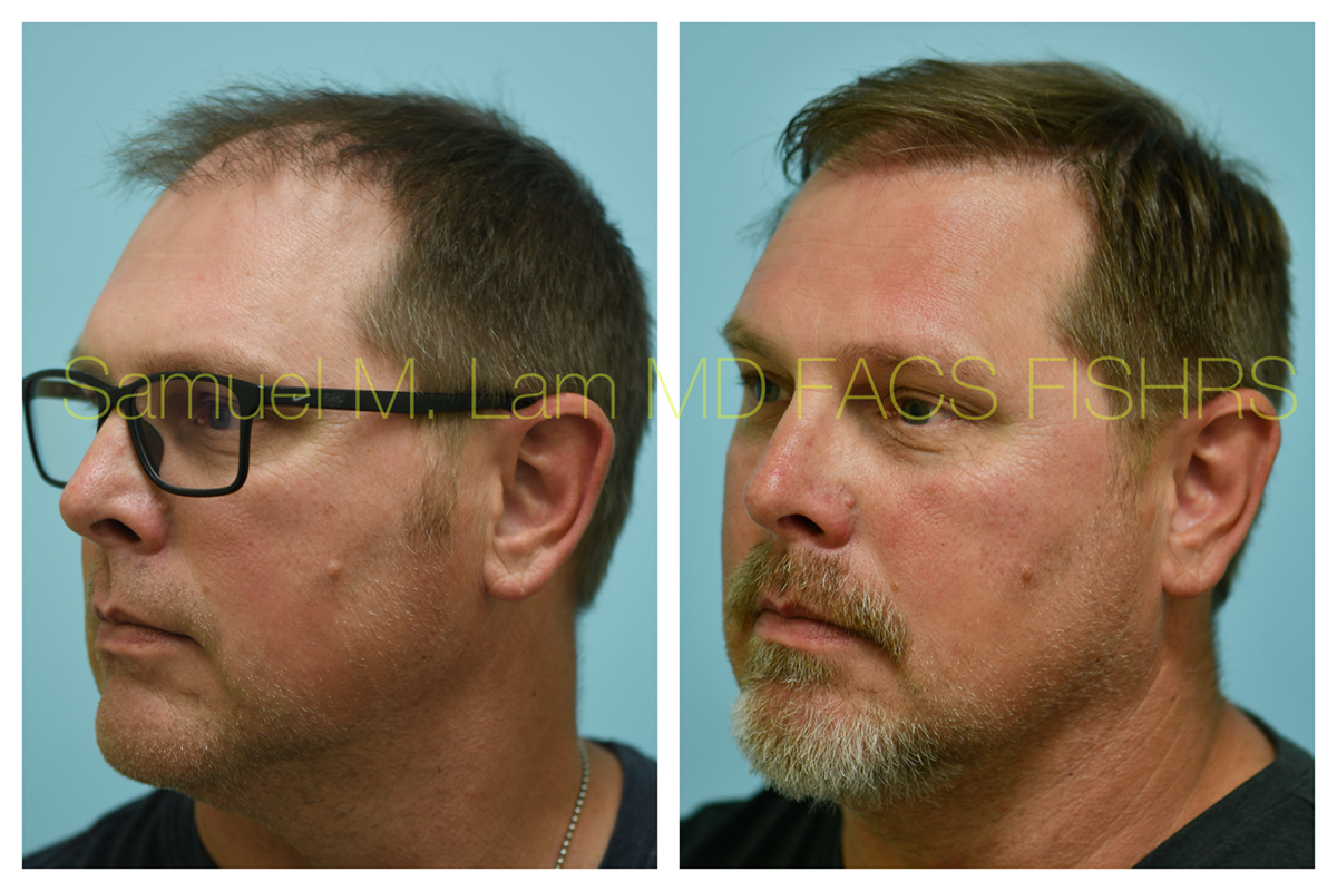 Hair Transplant Before and After Photo by Dr. Lam in Plano, TX