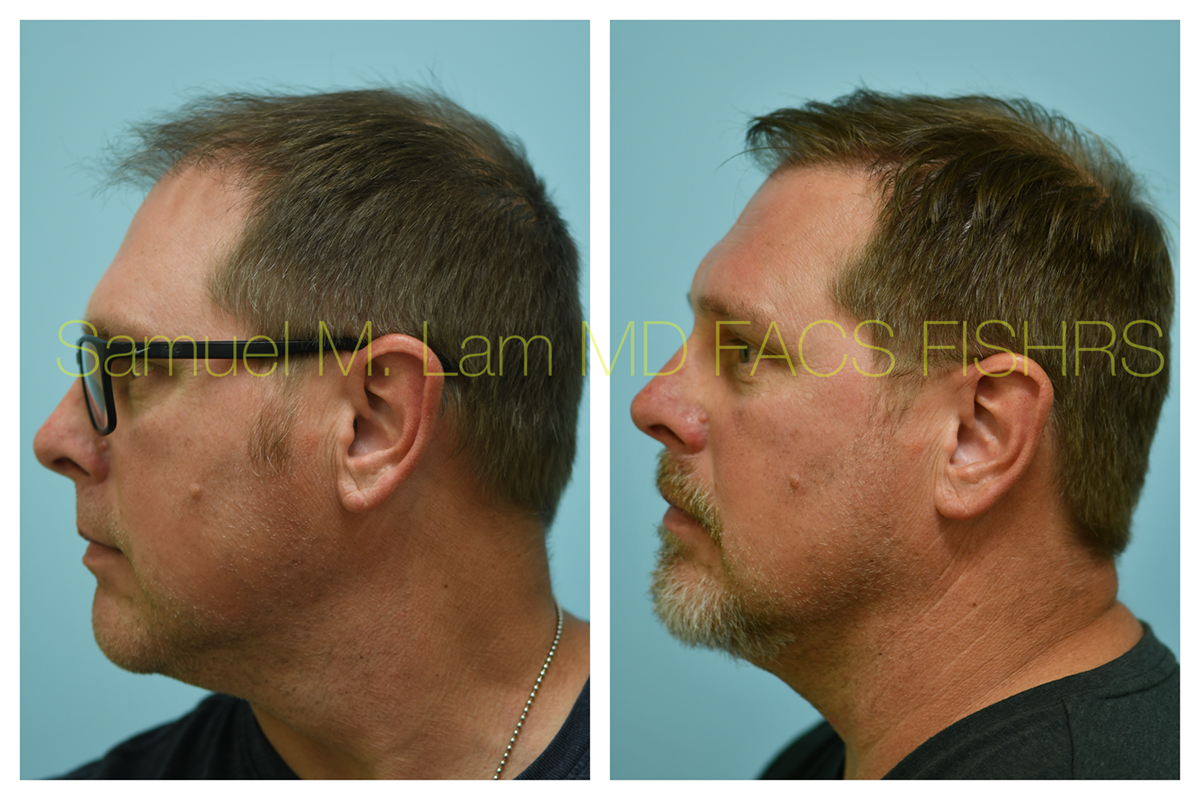 Hair Transplant Before and After Photo by Dr. Lam in Plano, TX