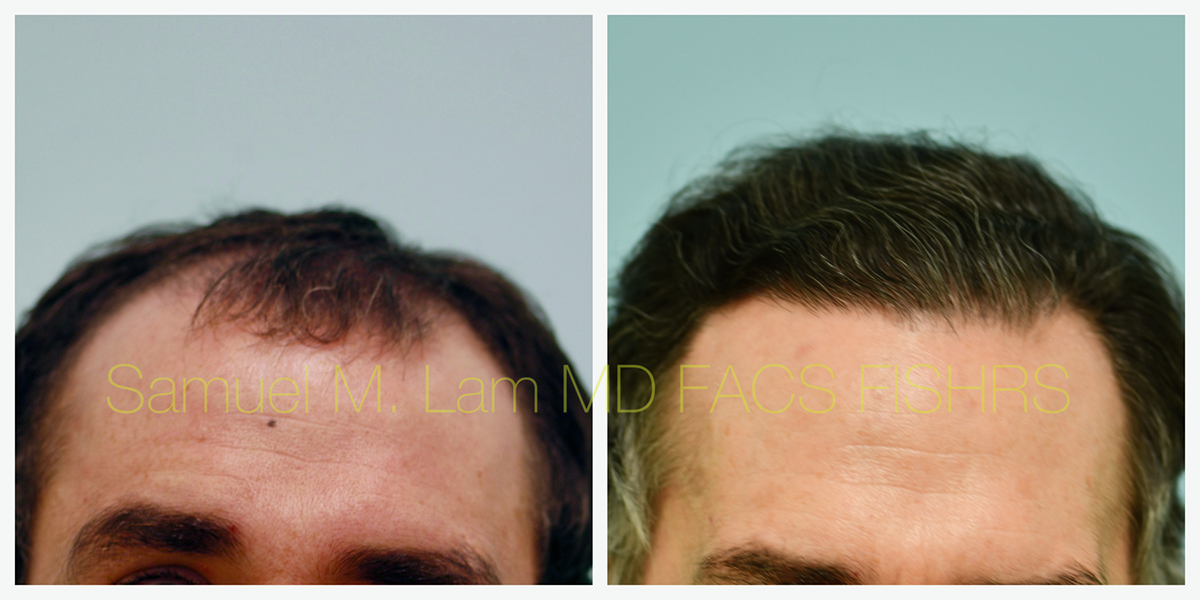 Hair Restoration Before and After Photo by Dr. Lam in Plano, TX