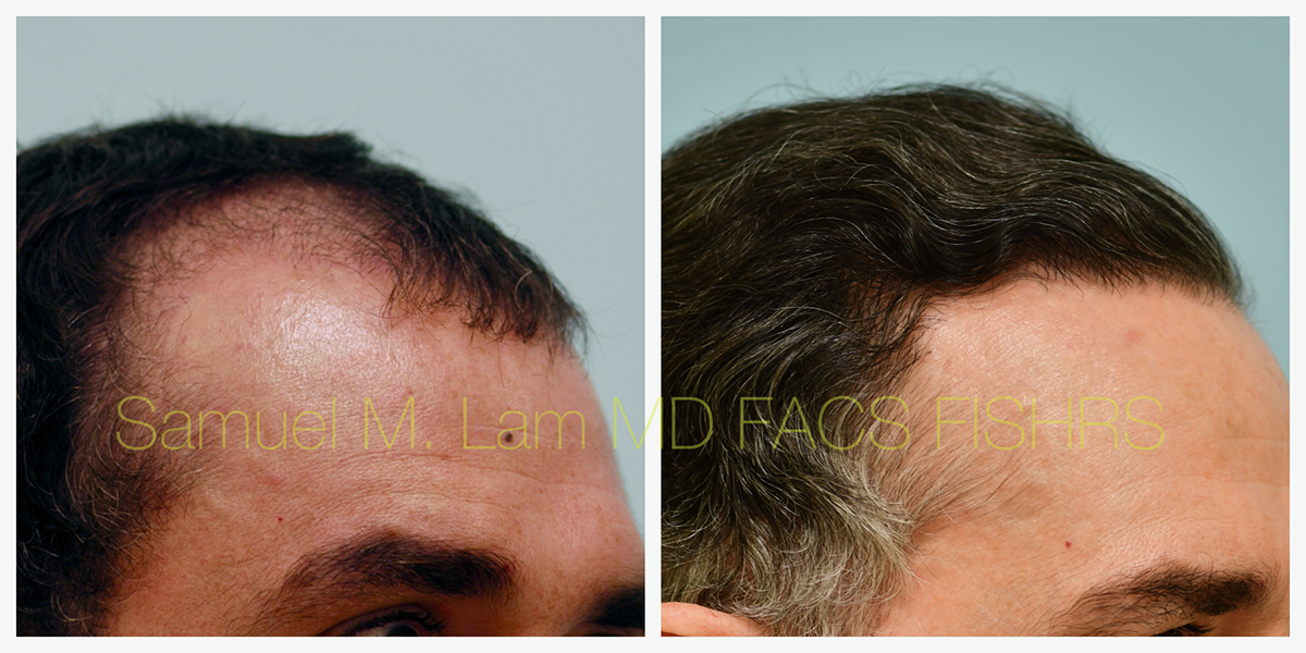 Hair Restoration Before and After Photo by Dr. Lam in Plano, TX