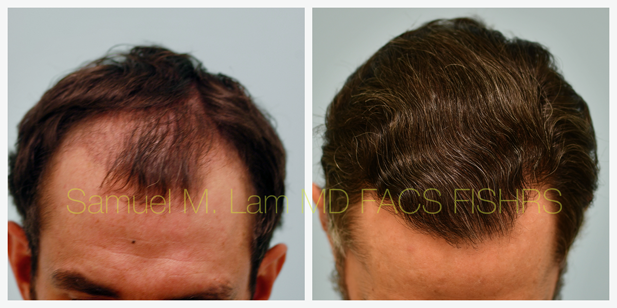 Hair Restoration Before and After Photo by Dr. Lam in Plano, TX