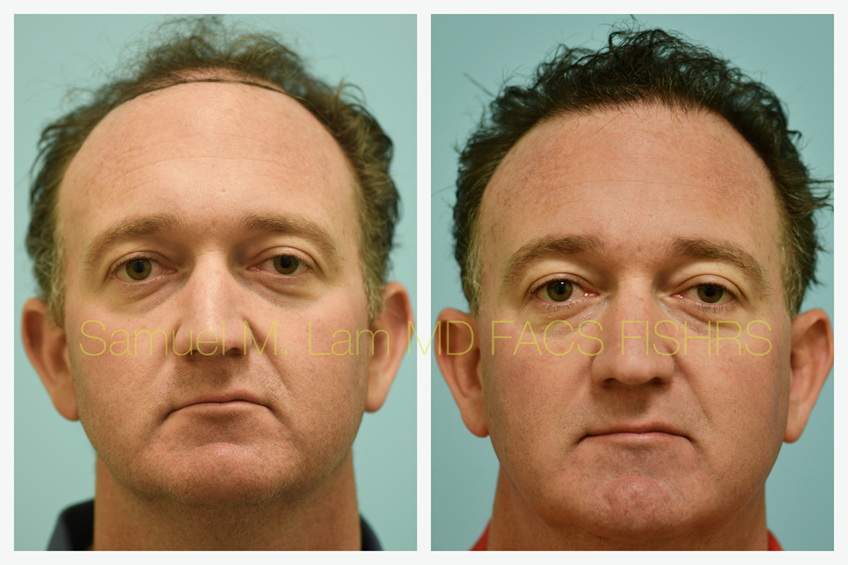 Hair Transplant Before and After Photo by Dr. Lam in Plano, TX