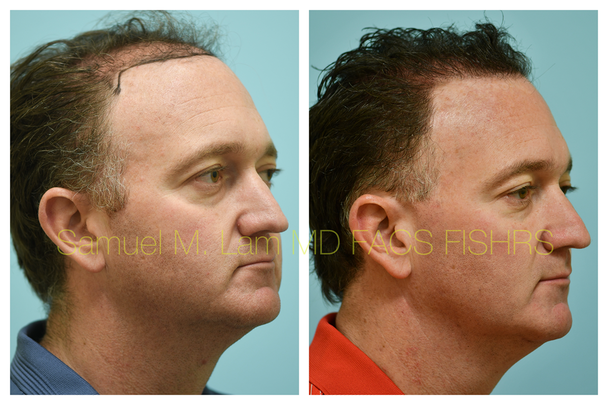 Hair Transplant Before and After Photo by Dr. Lam in Plano, TX