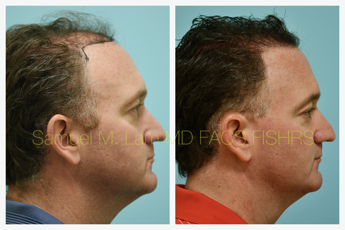 Hair Transplant Before and After Photo by Dr. Lam in Plano, TX