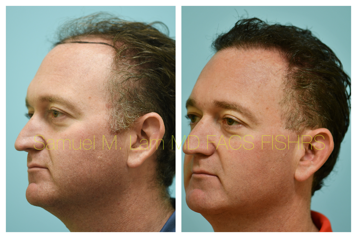 Hair Transplant Before and After Photo by Dr. Lam in Plano, TX