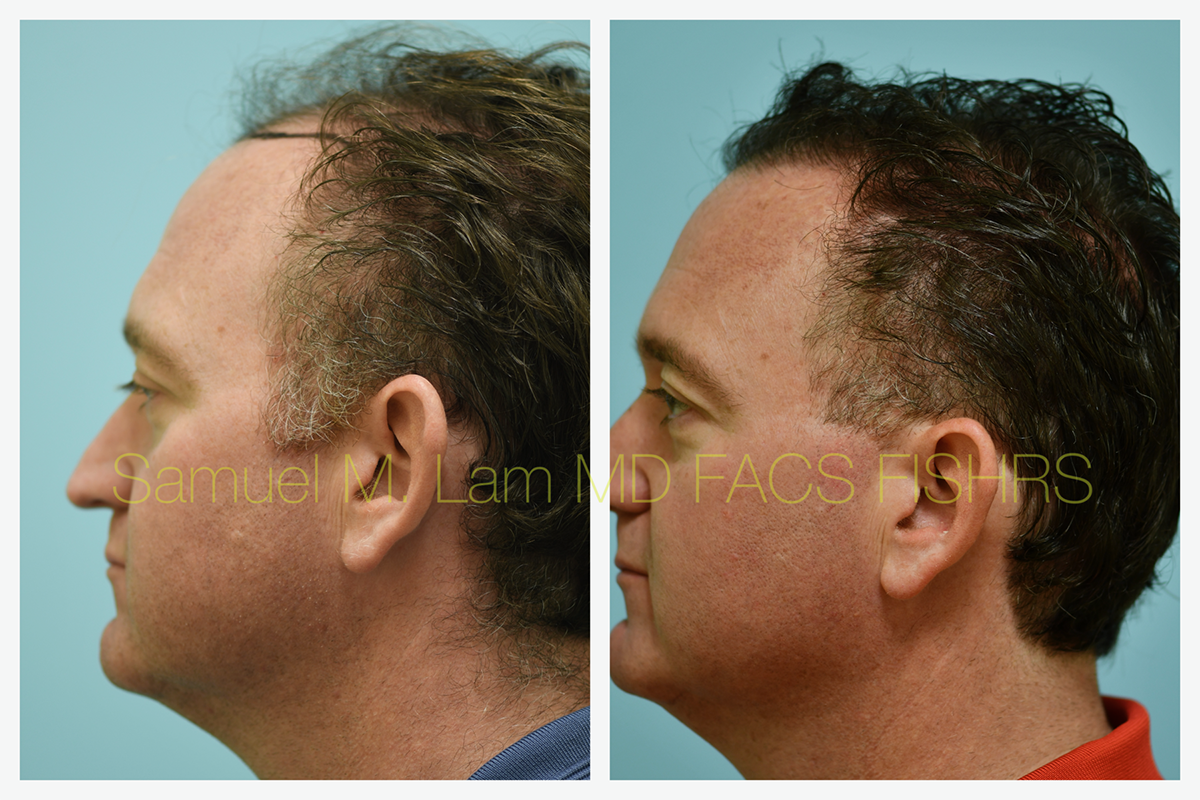 Hair Transplant Before and After Photo by Dr. Lam in Plano, TX