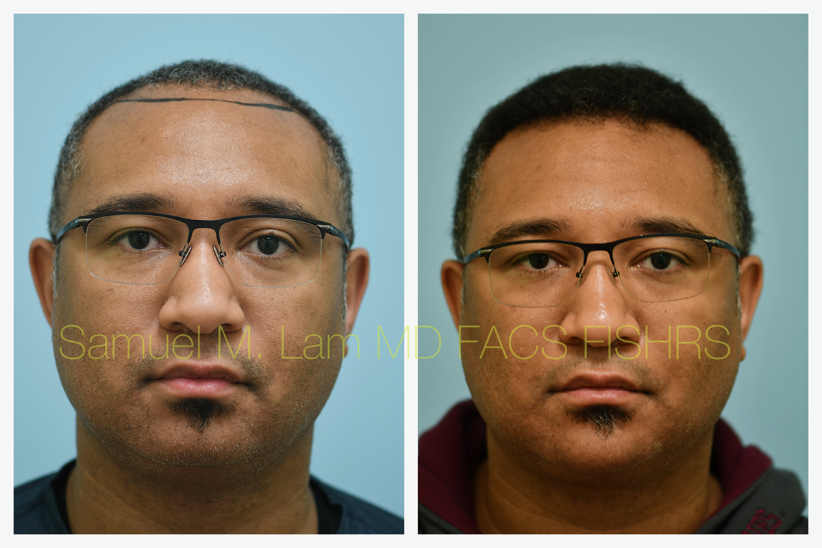 Hair Transplant FUE Before and After Photo by Dr. Lam in Plano, TX