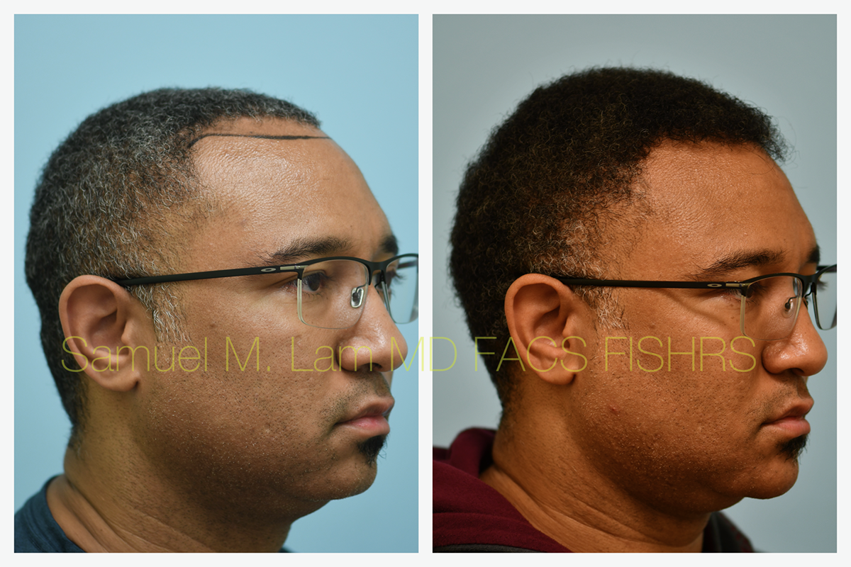 Hair Transplant FUE Before and After Photo by Dr. Lam in Plano, TX