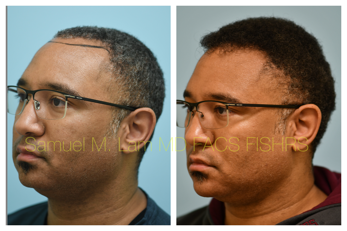 Hair Transplant FUE Before and After Photo by Dr. Lam in Plano, TX