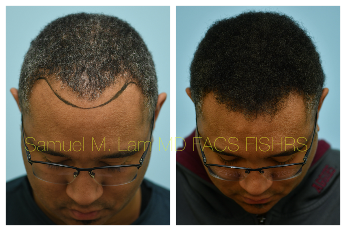 Hair Transplant FUE Before and After Photo by Dr. Lam in Plano, TX