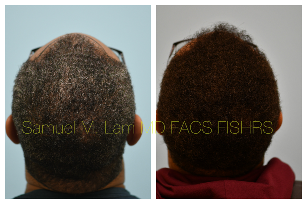 Hair Transplant FUE Before and After Photo by Dr. Lam in Plano, TX