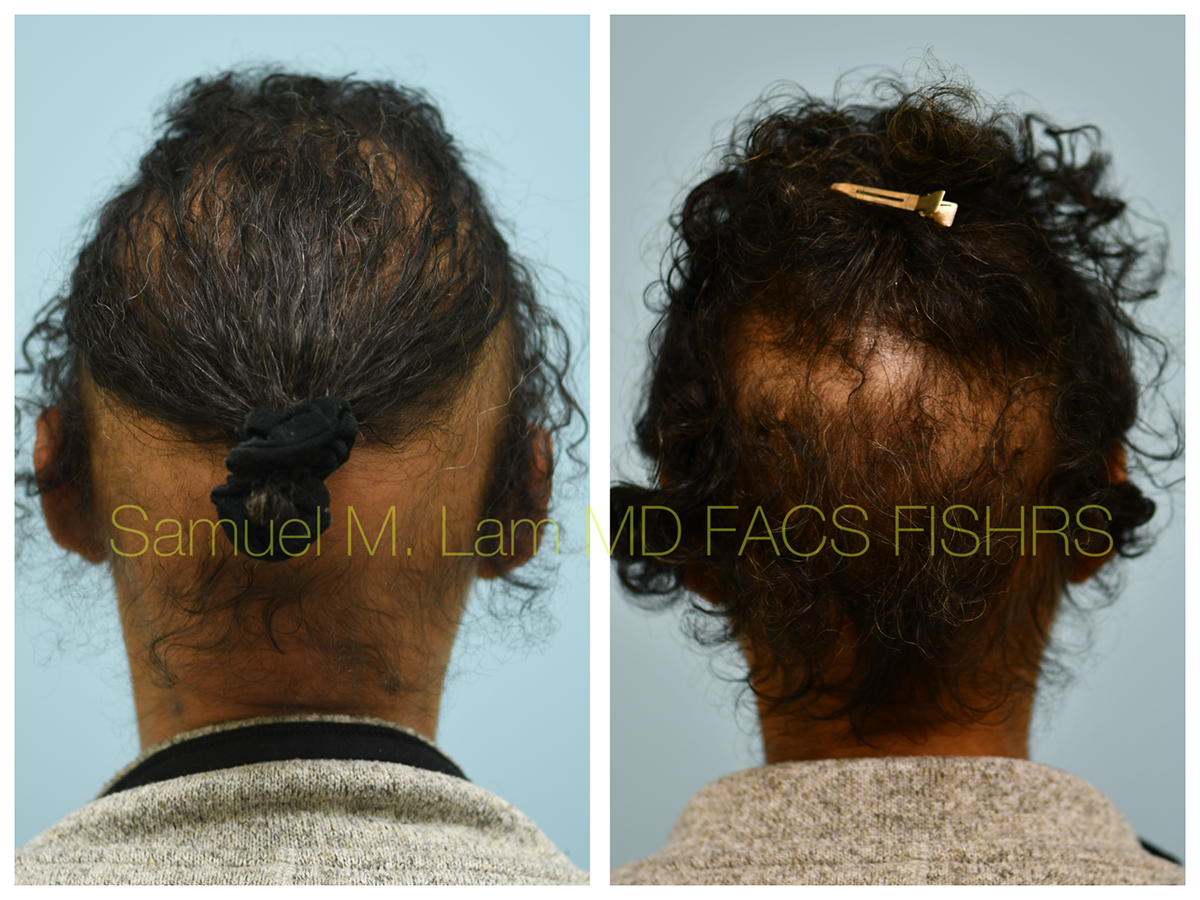 Hair Stem Before and After Photo by Dr. Lam in Plano, TX