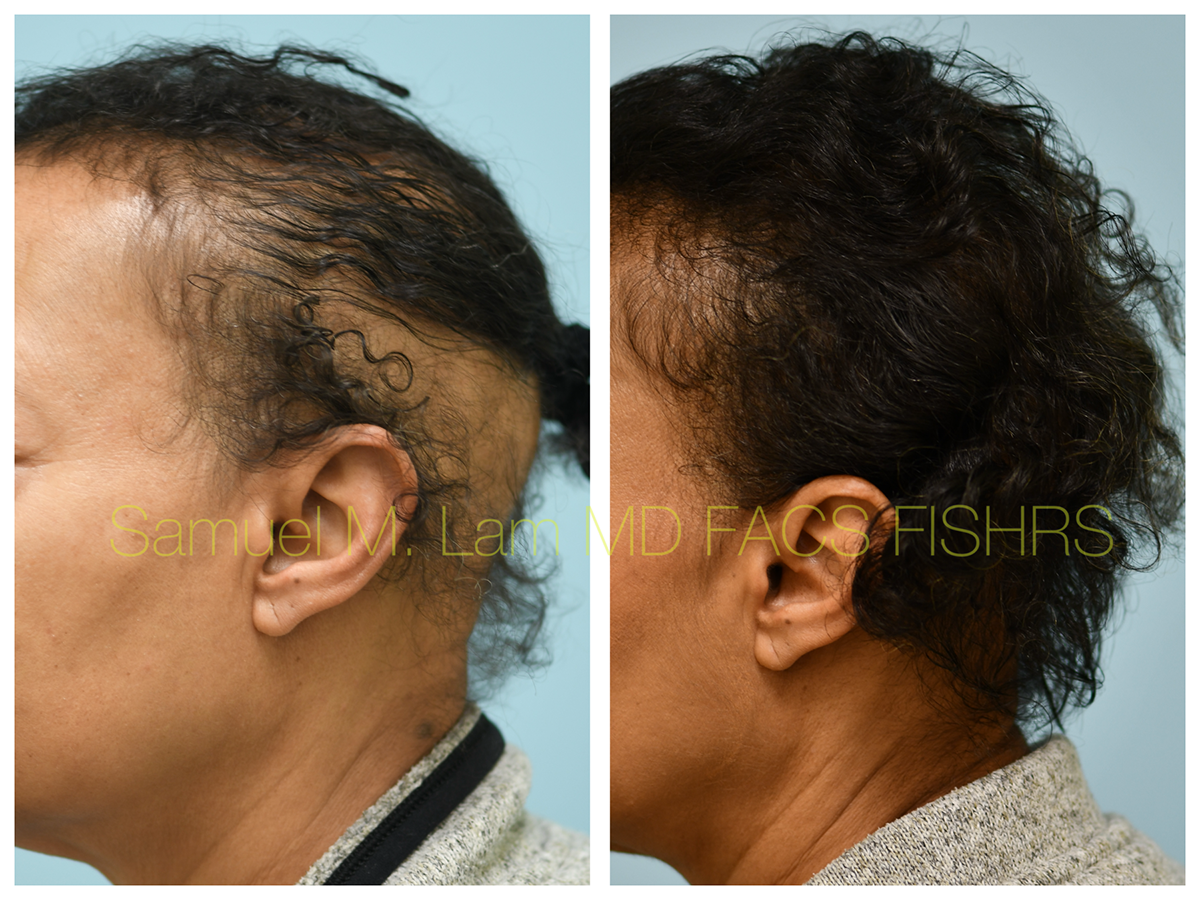 Hair Stem Before and After Photo by Dr. Lam in Plano, TX