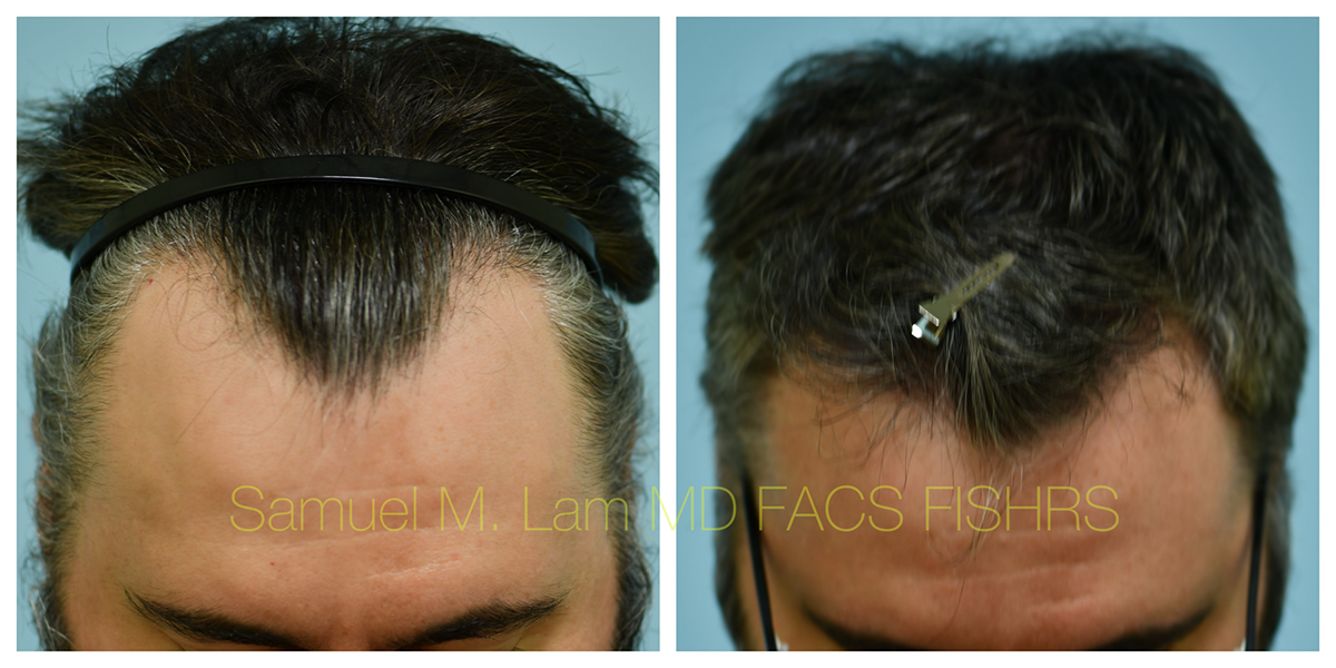 Hair Transplant Before and After Photo by Dr. Lam in Plano, TX