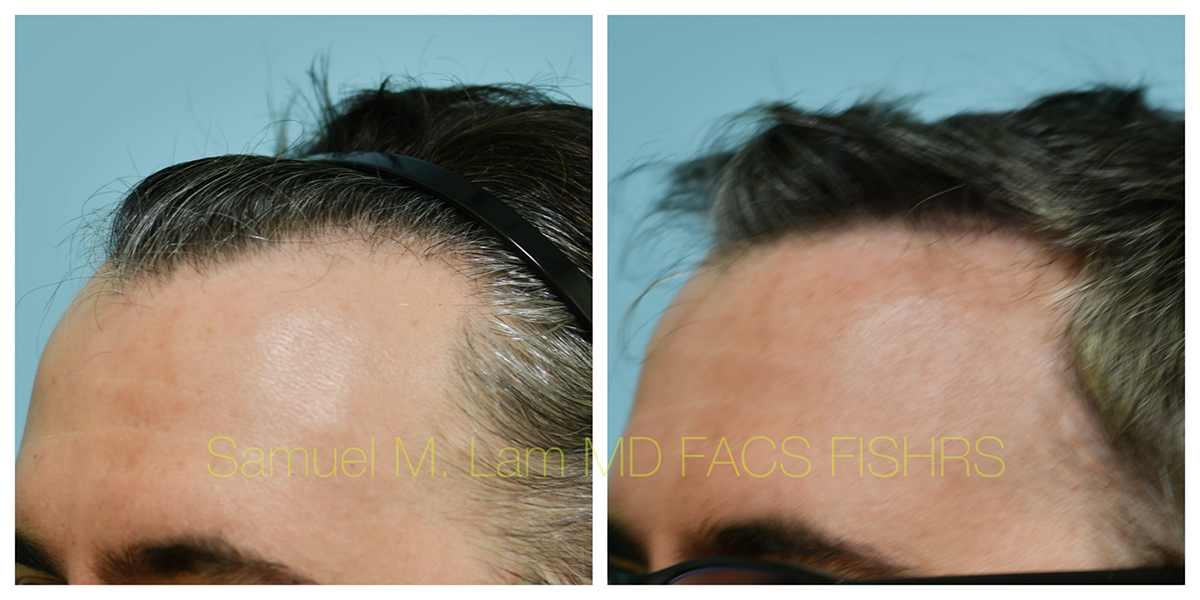 Hair Transplant Before and After Photo by Dr. Lam in Plano, TX