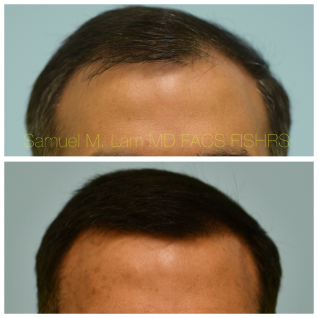 Crown (or vertex) Hair Restoration Before and After Photo by Dr. Lam in Plano, TX