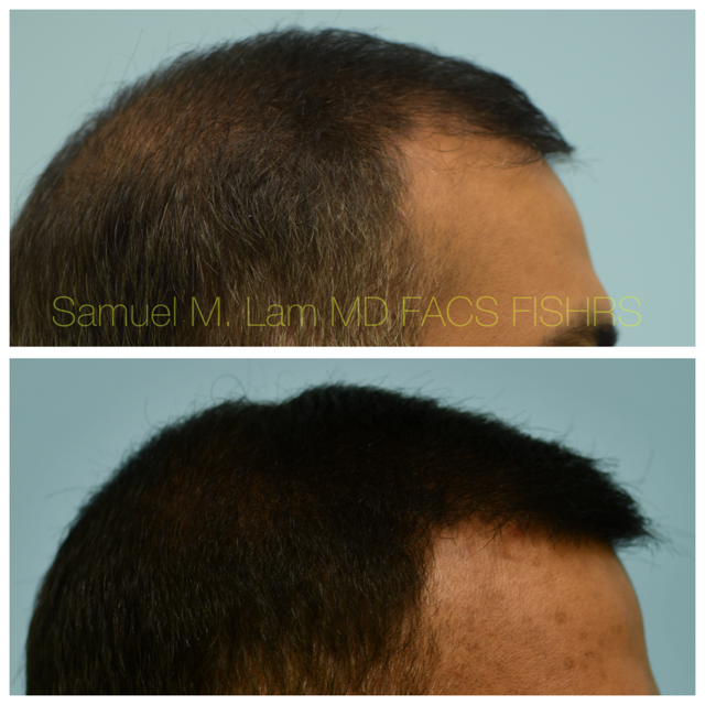 Crown (or vertex) Hair Restoration Before and After Photo by Dr. Lam in Plano, TX