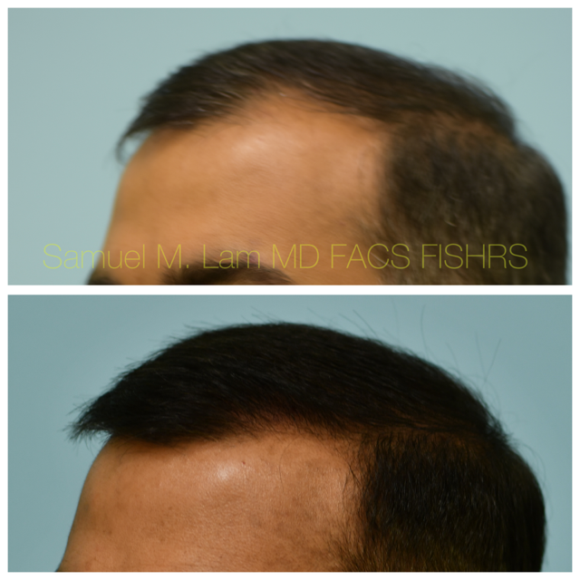 Crown (or vertex) Hair Restoration Before and After Photo by Dr. Lam in Plano, TX