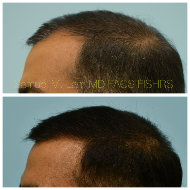 Crown (or vertex) Hair Restoration Before and After Photo by Dr. Lam in Plano, TX