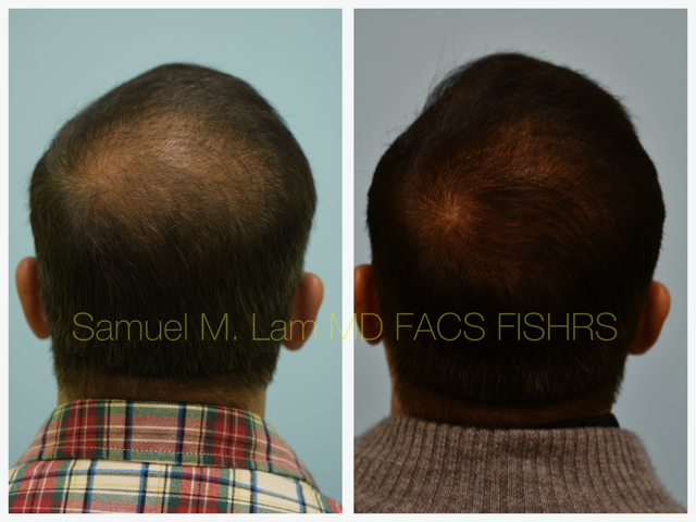 Crown (or vertex) Hair Restoration Before and After Photo by Dr. Lam in Plano, TX