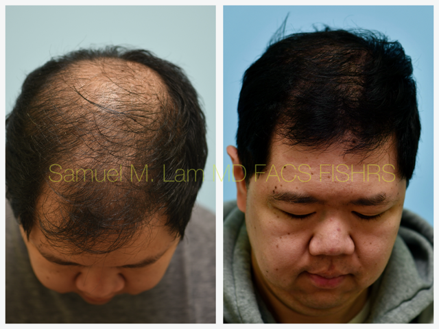 Hair Stem Therapy Before and After Photo by Dr. Lam in Plano, TX