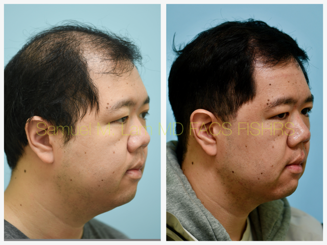 Hair Stem Therapy Before and After Photo by Dr. Lam in Plano, TX