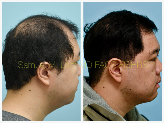 Hair Stem Therapy Before and After Photo by Dr. Lam in Plano, TX