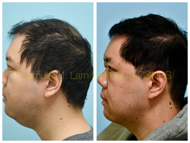 Hair Stem Therapy Before and After Photo by Dr. Lam in Plano, TX