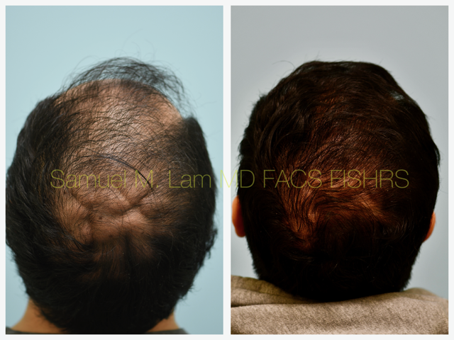 Hair Stem Therapy Before and After Photo by Dr. Lam in Plano, TX