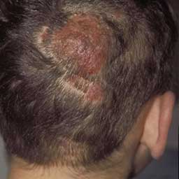 A) Clinical image showing kerion type of inflammatory tinea