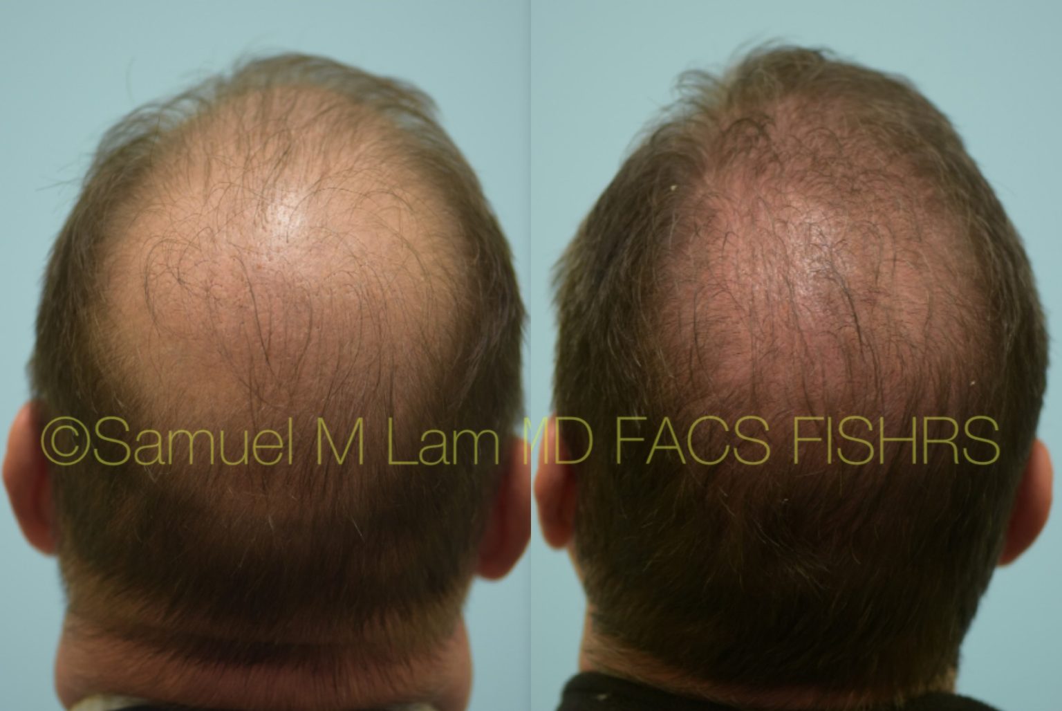 Dallas Finasteride And Minoxidil Before And After Photos Plano Plastic Surgery Photo Gallery 9114