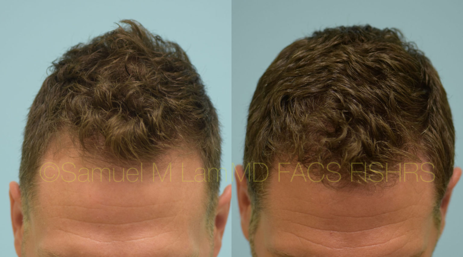 Dallas Finasteride And Minoxidil Before And After Photos - Plano ...