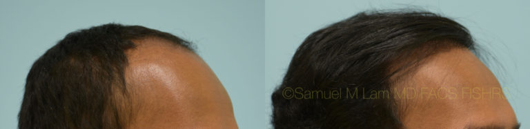 Dallas Hairline And Central Density Hair Restoration Before And After Photos Plano Plastic 